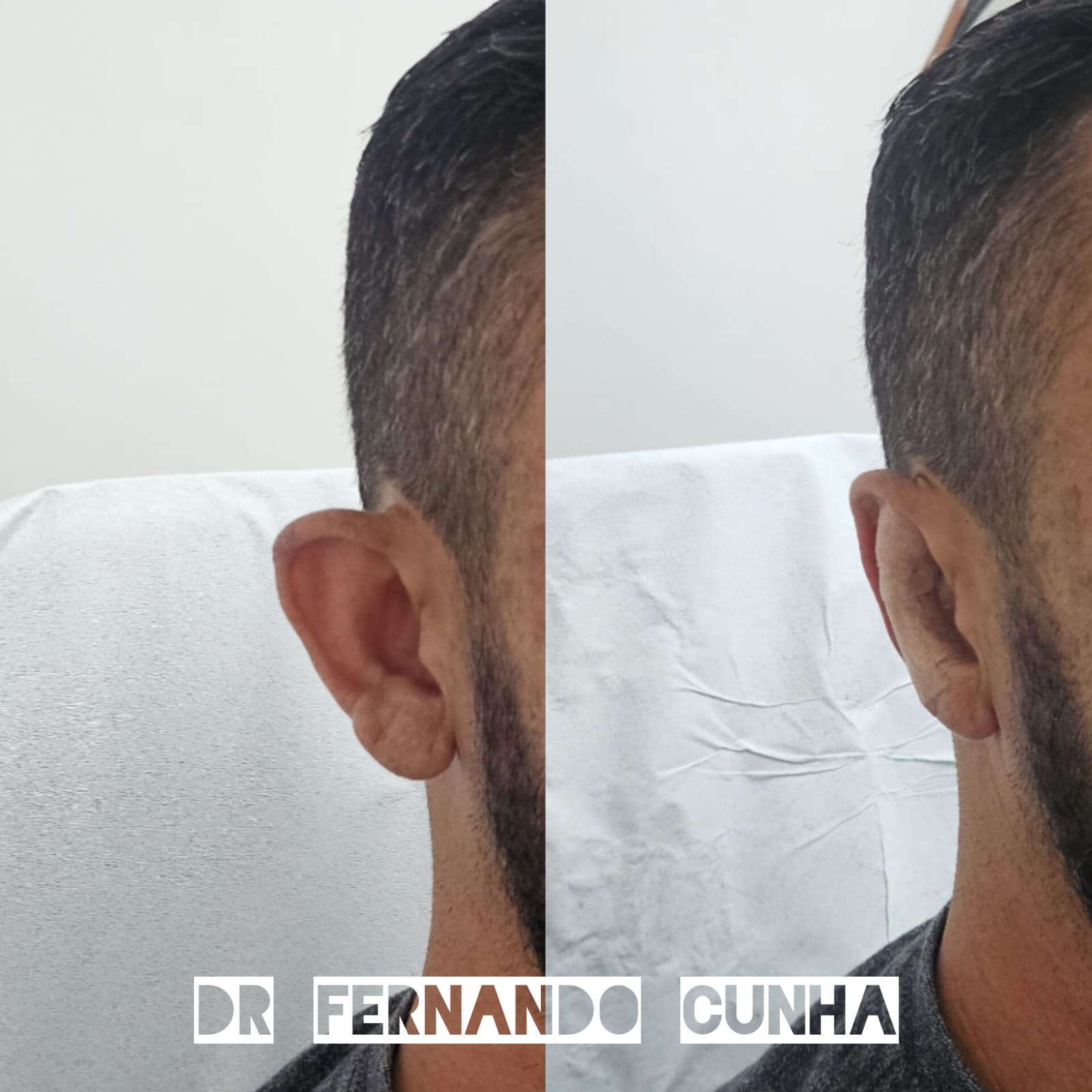 Harmonização de Orelhas antes e depois 09