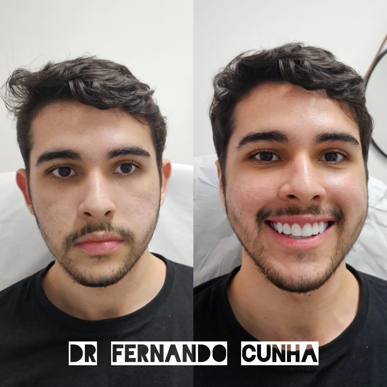 Otomodelação antes e depois 19