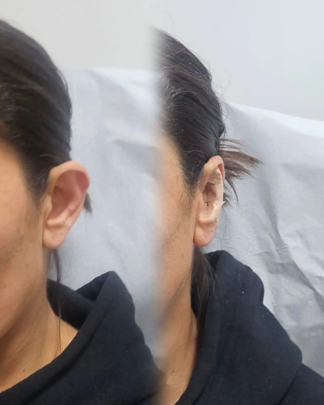 Otomodelação antes e depois 22