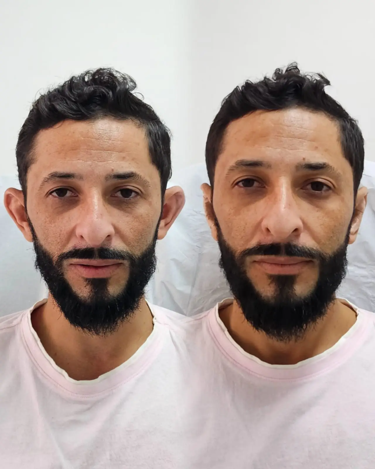Otomodelação antes e depois 23